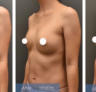 療程效果因人而異，上圖為A罩杯產後女性在做完自體脂肪隆乳之後​手術後一個月、手術後五個月成效